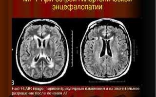Алкогольная энцефалопатия код по мкб 10 у взрослых