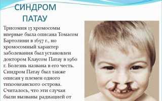 Трисомия по 13 паре хромосом синдром патау