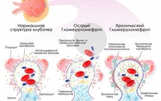 Хронический гломерулонефрит с изолированным мочевым синдромом у ребенка