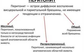 Каловый перитонит код мкб