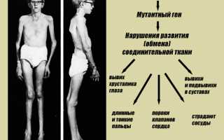 Физические упражнения при синдроме марфана