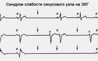 Синдром слабости синусового узла на экг