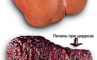 Цирроз печени при гепатите с код по мкб 10