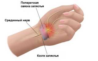 Упражнения при туннельном синдроме пальцев