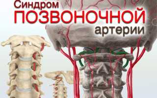 Мази при синдроме позвоночной артерии