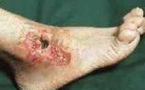 Хронические трофические язвы код по мкб 10