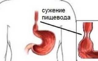 Код мкб стриктура пищевода