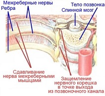 Межреберная невралгия