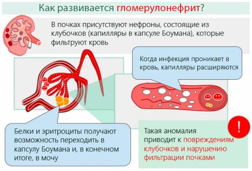 Хронический гломерулонефрит с изолированным мочевым синдромом у ребенка