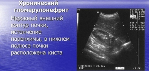Хронический гломерулонефрит с изолированным мочевым синдромом у ребенка