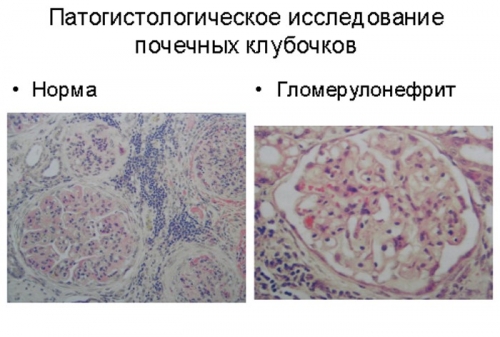 Хронический гломерулонефрит с изолированным мочевым синдромом у ребенка
