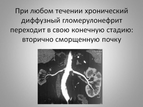 Хронический гломерулонефрит с изолированным мочевым синдромом у ребенка