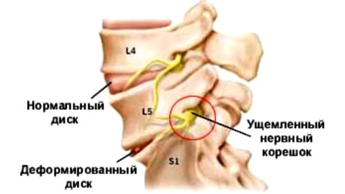Корешковые синдромы при поясничном остеохондрозе чем лечить