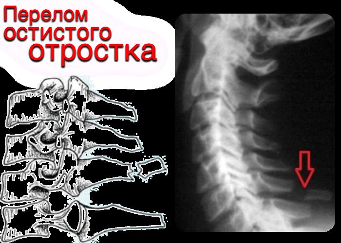 Код мкб компрессионный перелом позвоночника