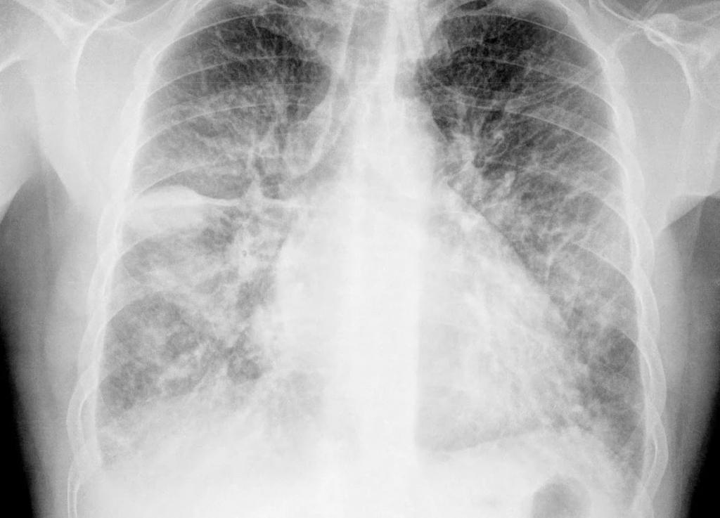 Диагностика саркоидоза