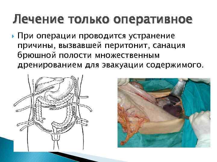Каловый перитонит код мкб
