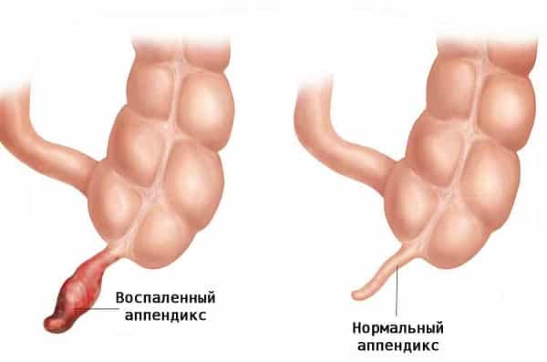 Гангренозный аппендицит