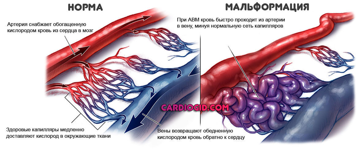 Мальформация