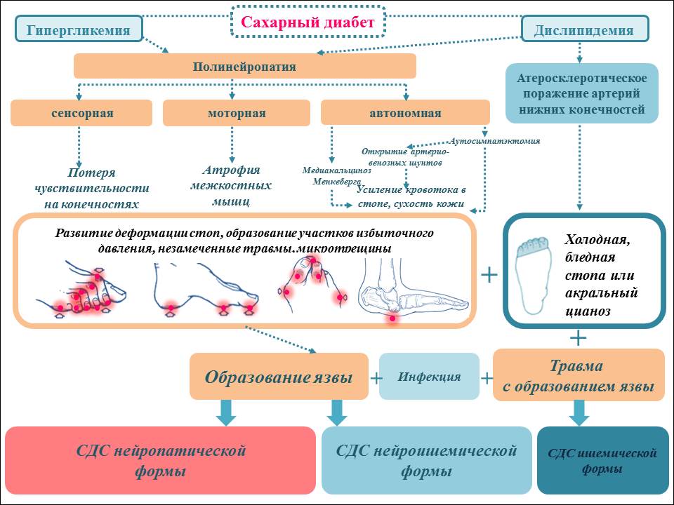 ПАТОГЕНЕЗ синдрома диабетической стопы