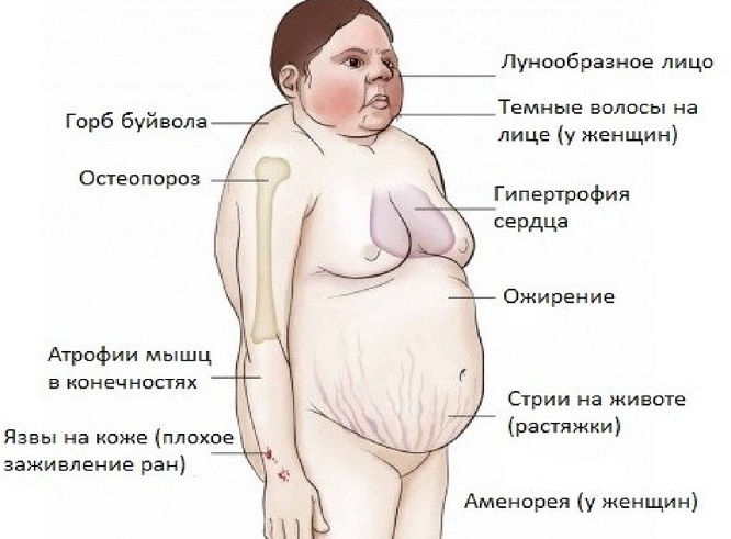Синдром иценко кушинга фото больного
