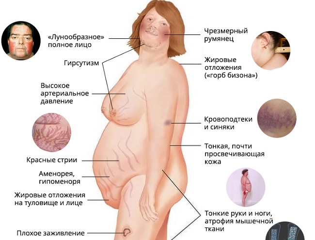 Синдром иценко кушинга фото больного