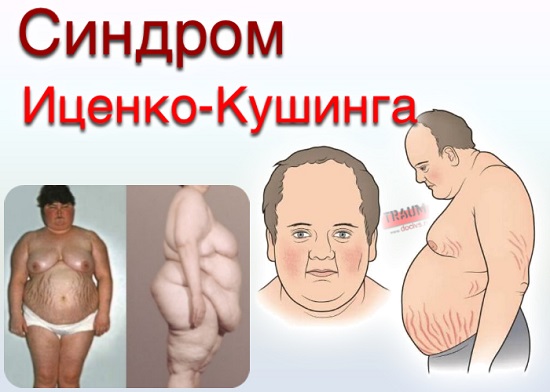 Синдром иценко кушинга фото больного