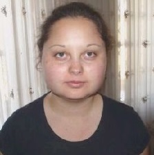 Синдром иценко кушинга фото больного