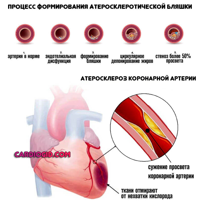 атеросклероз-коронарной-артерии