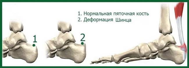 болезнь Шинца