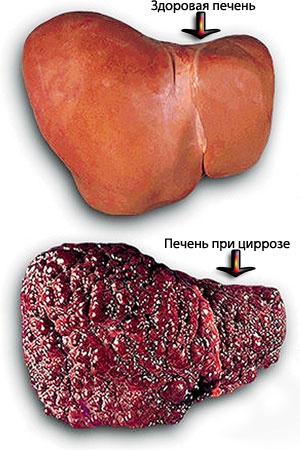 Изменение печени при циррозе