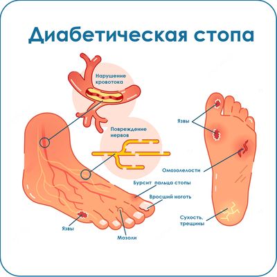 Уход при синдроме диабетической стопы