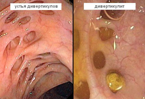 Развитие дивертикулита кишечной стенки