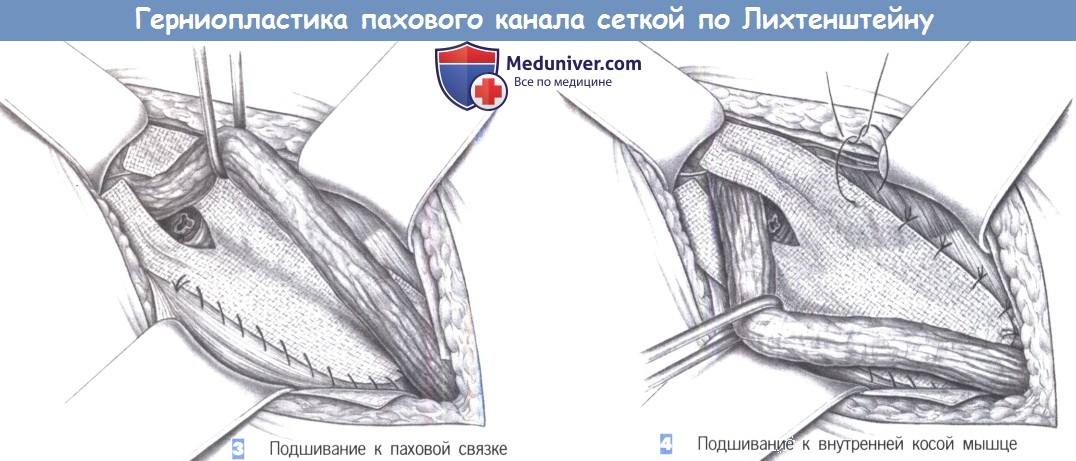 Этапы и техника герниопластики паховой грыжи сеткой по Лихтенштейну