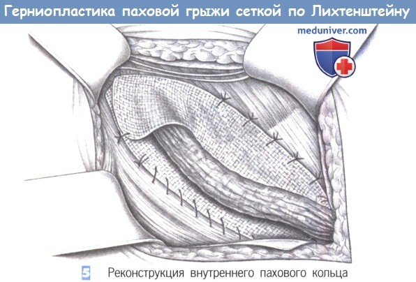 Этапы и техника герниопластики паховой грыжи сеткой по Лихтенштейну
