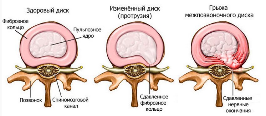 Разновидности и стадии развития грыжи