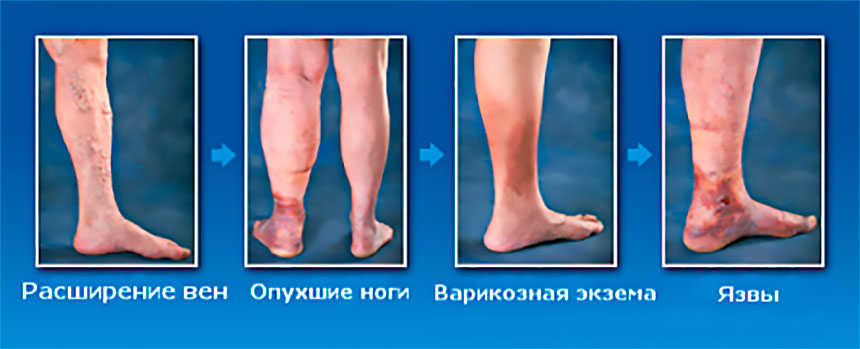 Варикозные трофические язвы