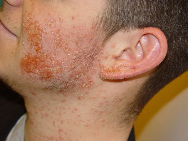 impetigo-piodermiya