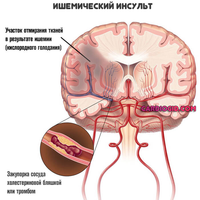 ишемический-инсульт