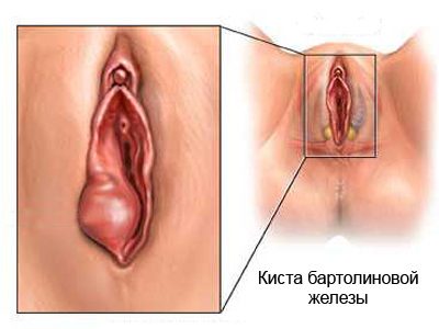 Киста бартолиновой железы