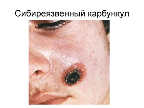 Фурункулез код мкб 10