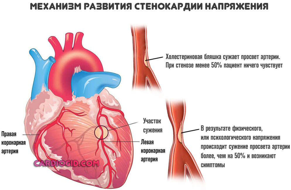 стенокардия напряжения