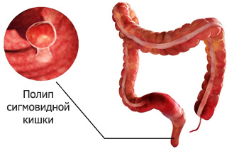 Полипы в сигмовидной кишке
