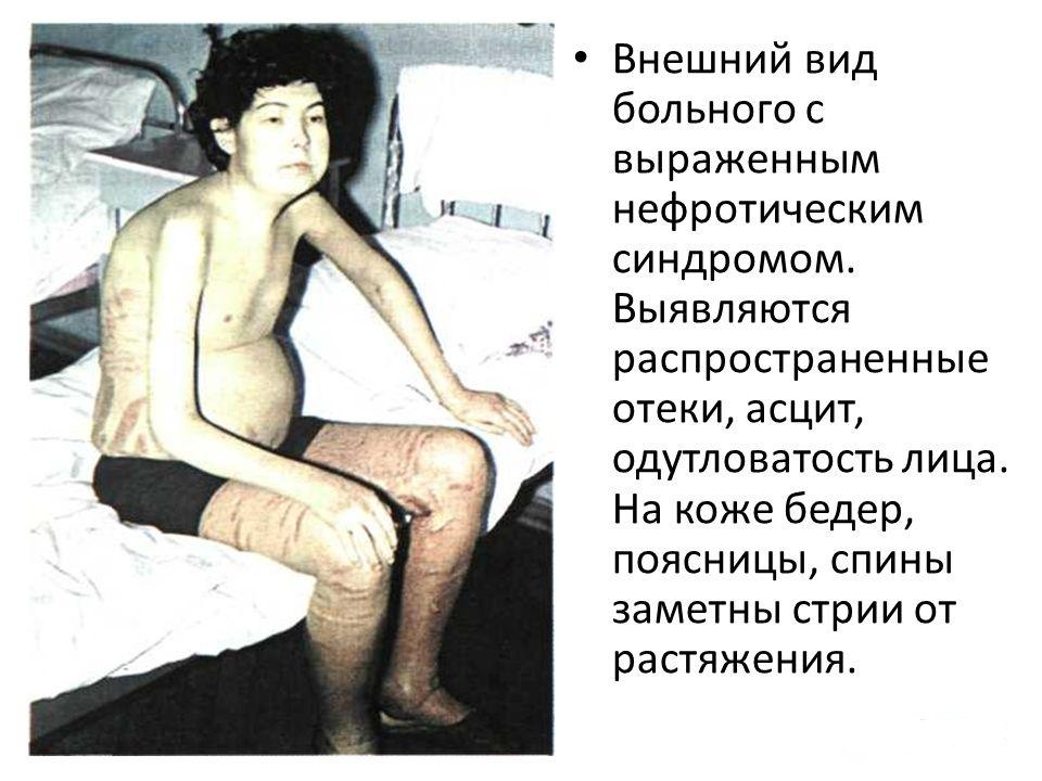 симптомы нефротического синдрома