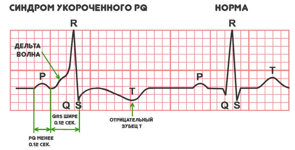 Мкб 10 укороченный синдром pq