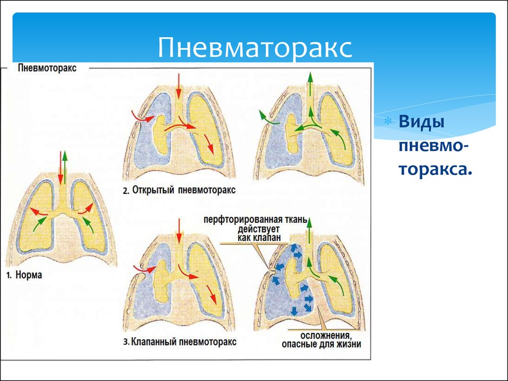 Ушиб молочной железы код мкб