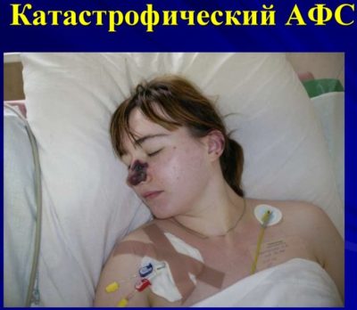 Ведение беременности с антифосфолипидным синдромом
