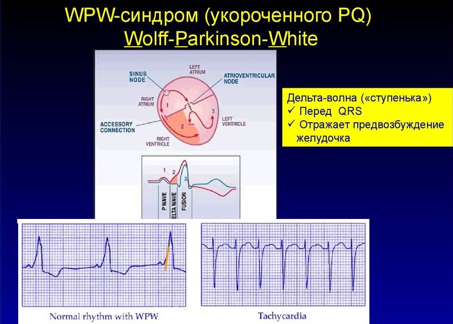 Мкб 10 укороченный синдром pq