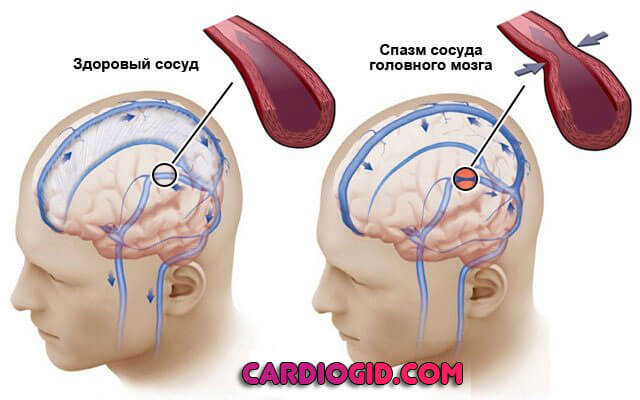 спазм-сосудов-мозга
