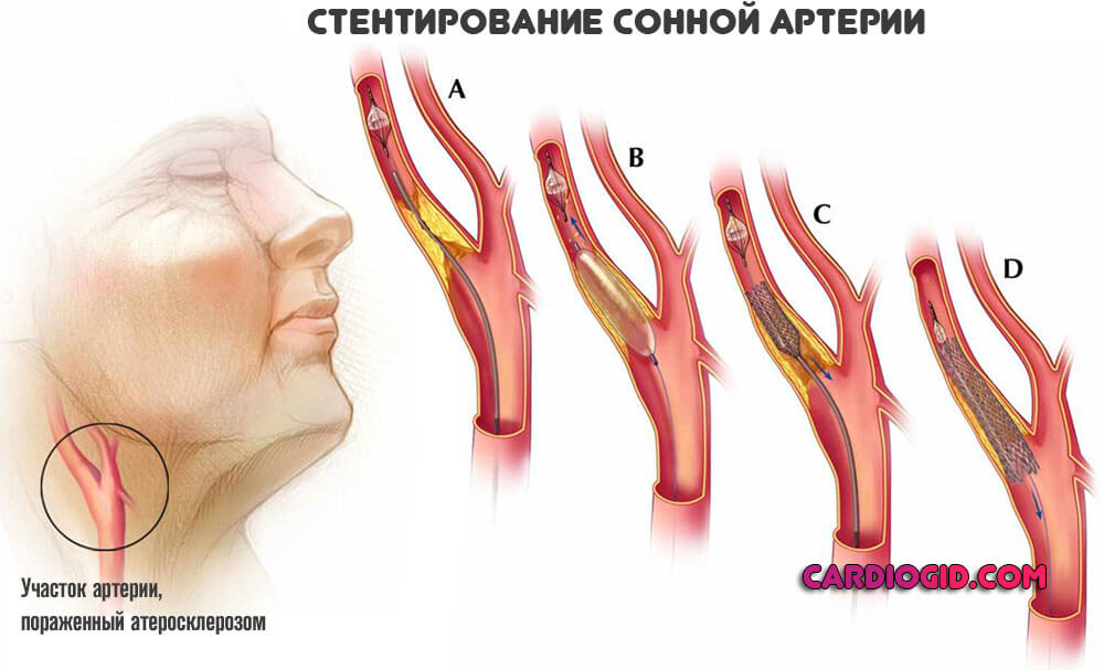 стентирование-сонной-артерии