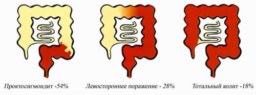 Колиты